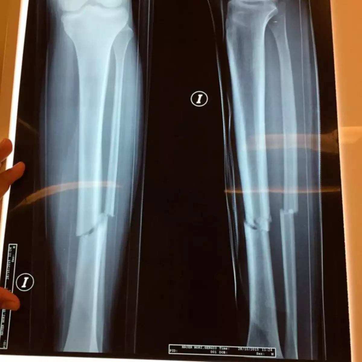 Esta es la radiografía de la fractura que tuvo Sergio Mayer Mori.