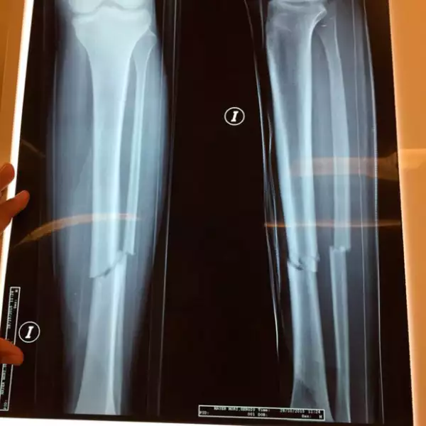 Esta es la radiografía de la fractura que tuvo Sergio Mayer Mori.