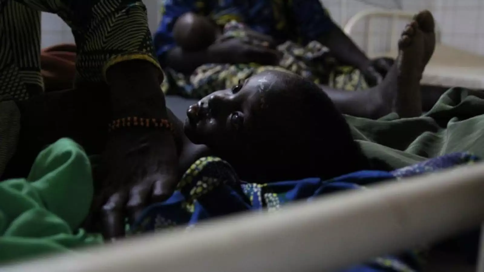 Áfríca - niña con sarampión