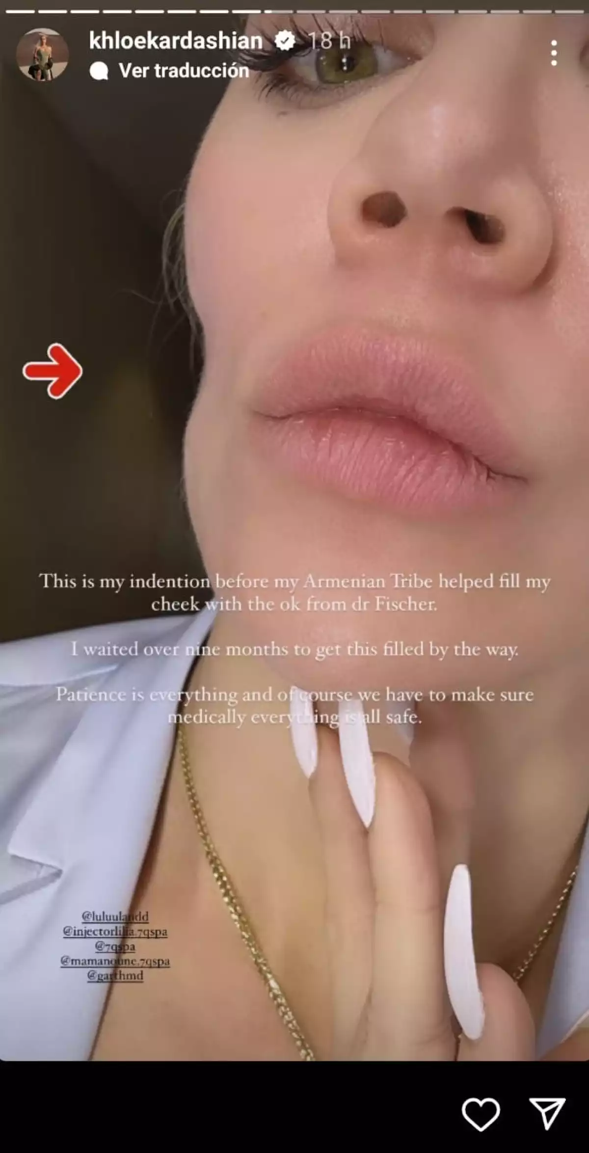 khloe-kardashian-tumor-en-la-cara.jpg