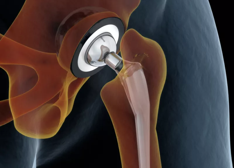 Medically accurate illustration of the hip replacement. 3d illustration.