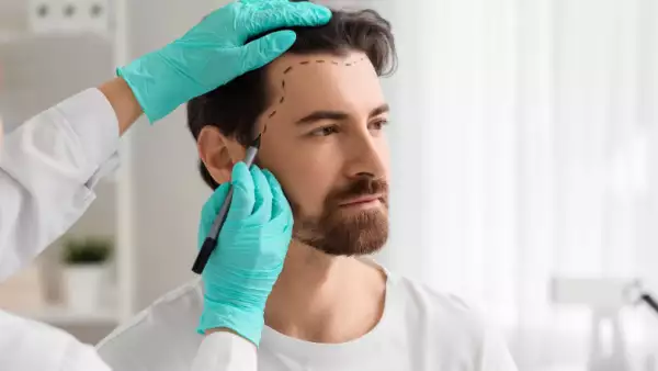 trasplante de cabello nueva (1).png