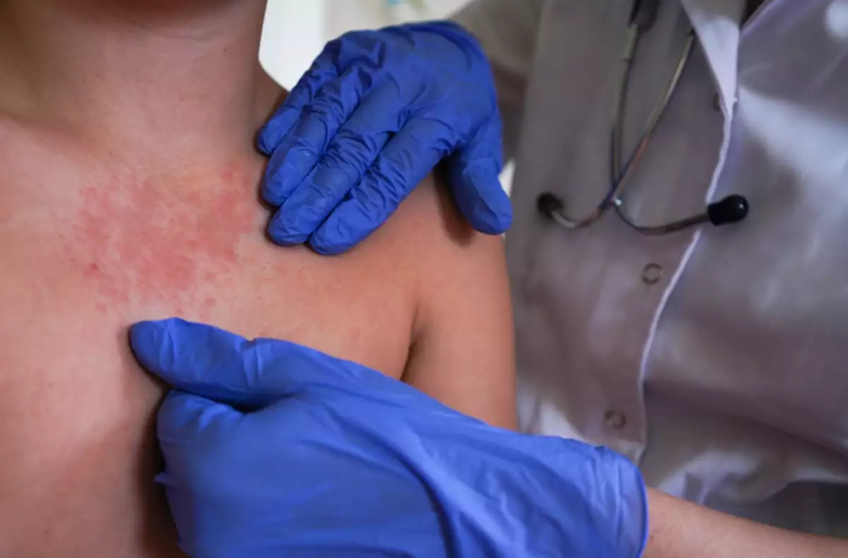 Ceguera, fallo renal y la muerte: Las complicaciones que provoca el sarampión