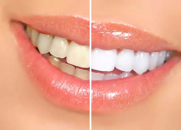 Woman,Teeth,Before,And,After,Whitening.,Over,White,Background