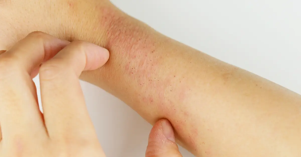 estres-dermatitis-atopica-.jpg