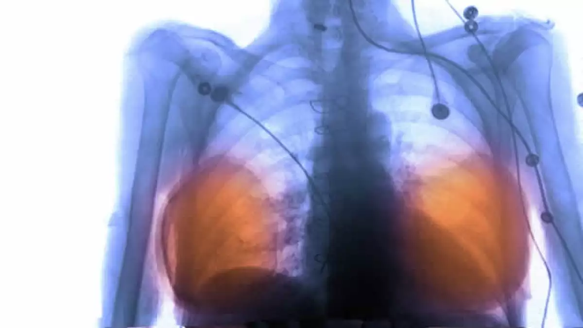 xray