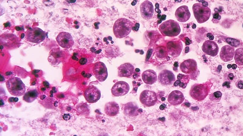 ameba que afecta al cerebro