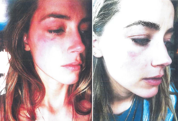 Estas fueron algunas de las fotografías que Amber presentó ante la corte como evidencia de violencia doméstica.