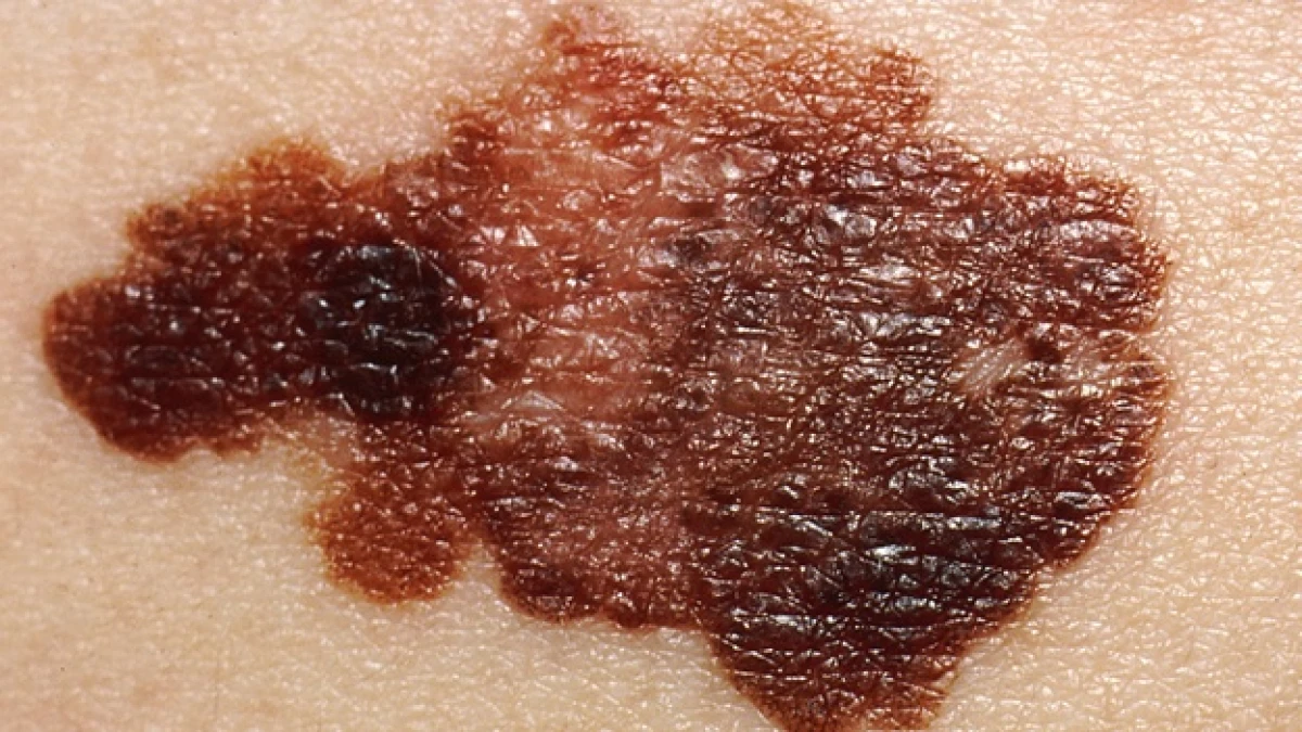 skin