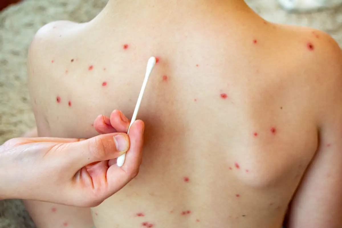 ¿El sarampión es contagioso? Estos son los síntomas en niños y adulto