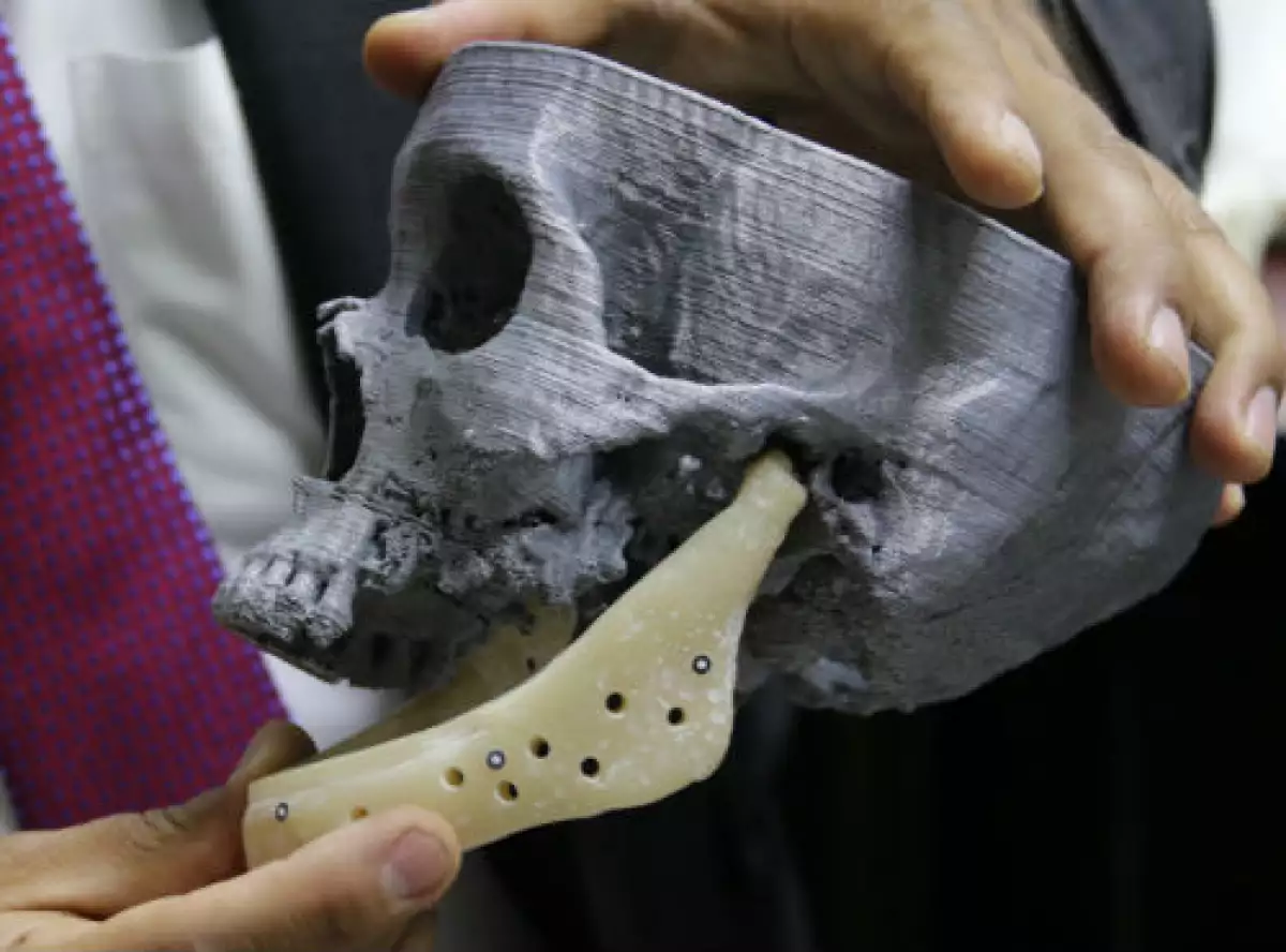 implantes de mand�bula en impresi�n 3D