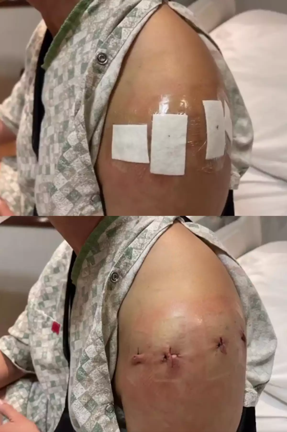 Lupita Jones impacta con operación en el hombro fotos