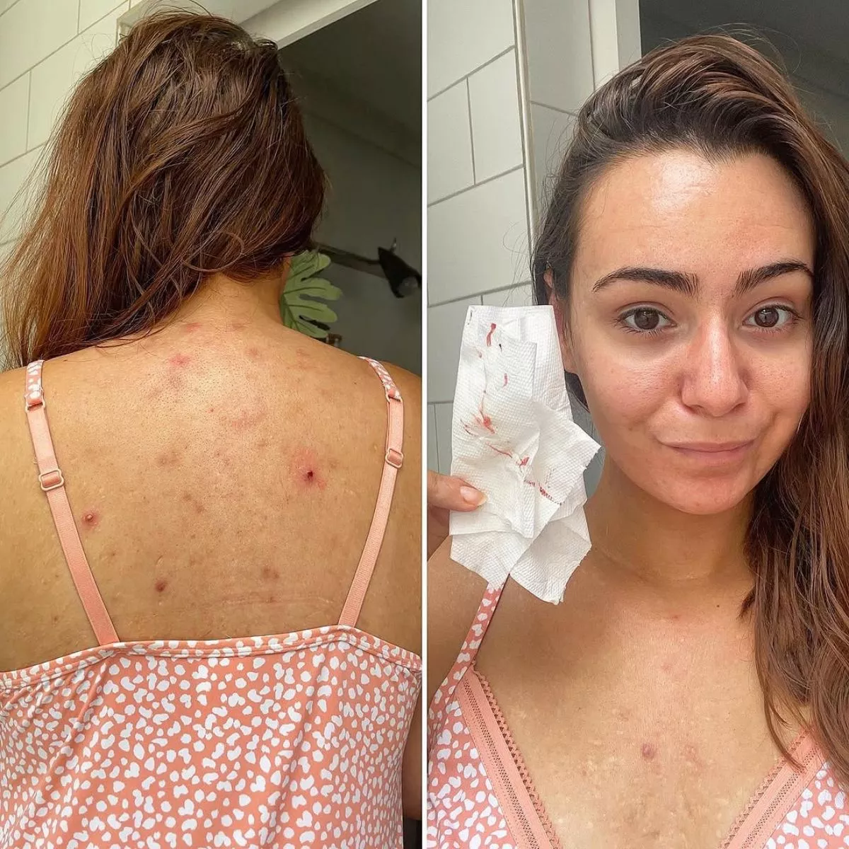 body acne 2.jpg