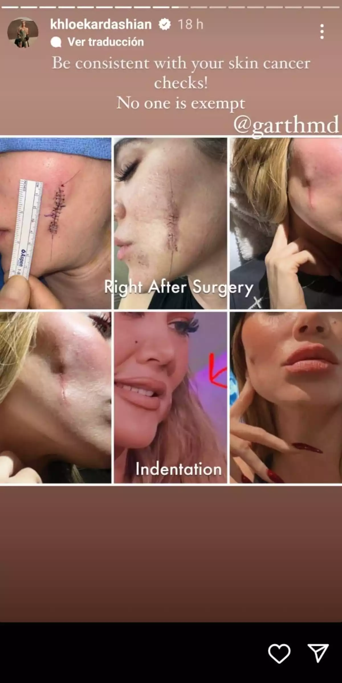 Khloé-Kardashian-tumor-en-la-cara.jpg