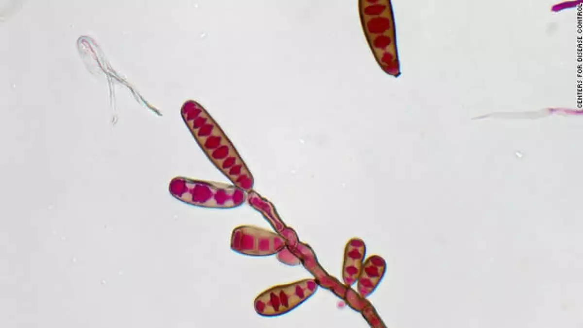 hongo meningitis