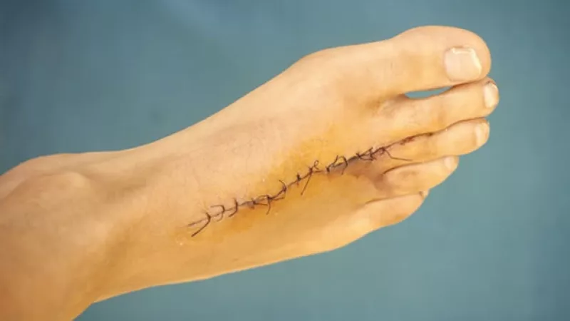 cirugia sutura pie coser 