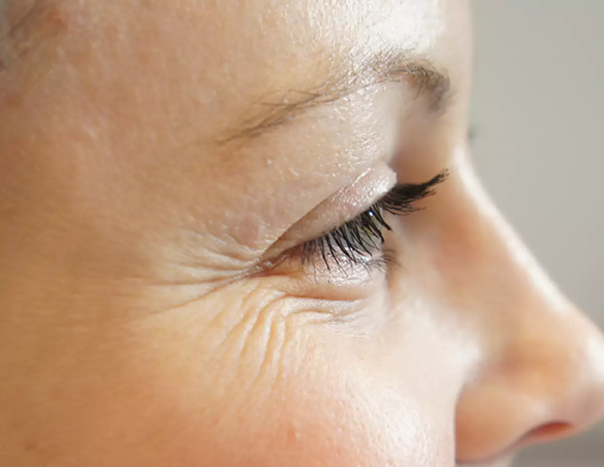 Las patas de gallo son muy comunes pero pueden ser causadas por no ver bien.