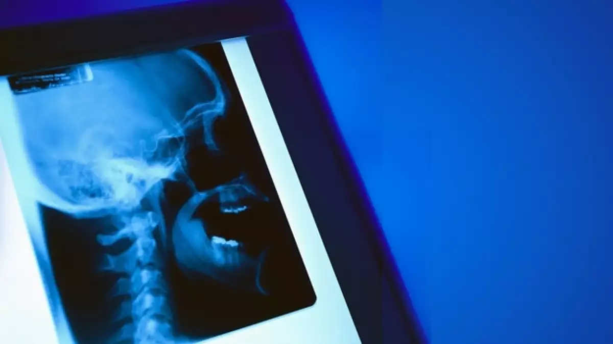 osteoporosis cancer