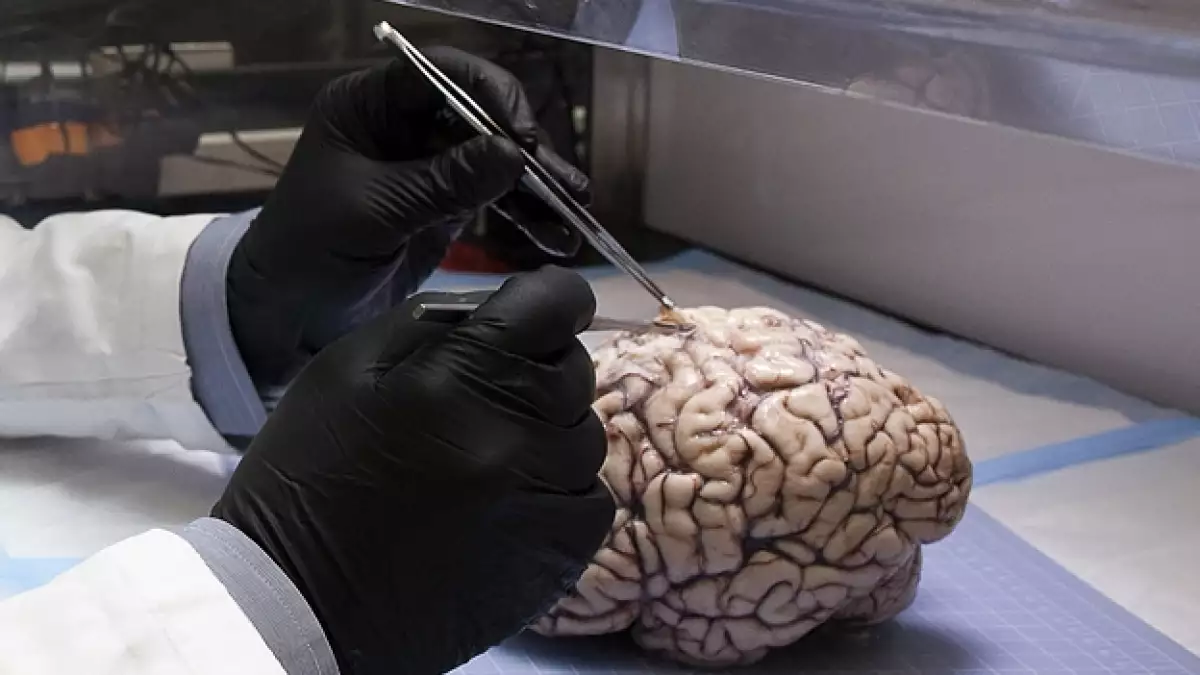 cerebro