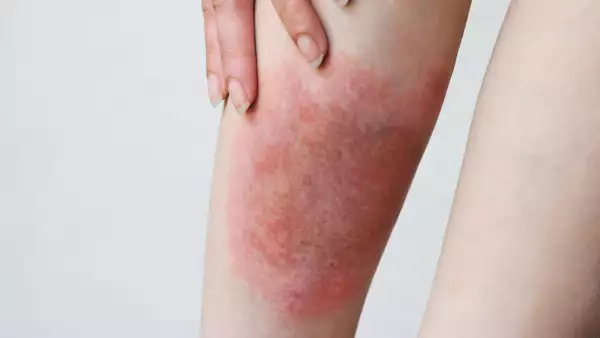 que-es-enfermedad-lyme