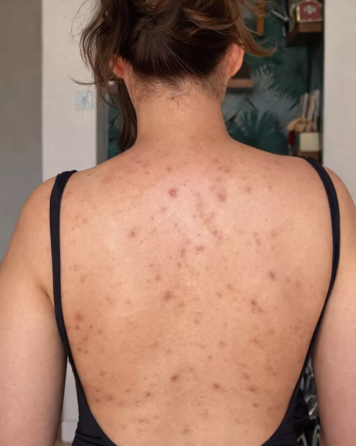 body acne.png