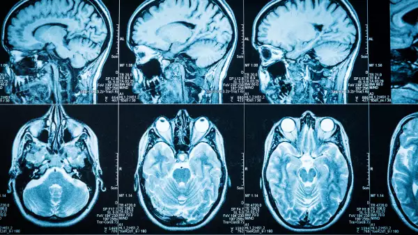 Reducción del cerebro, otro de los efectos del COVID-19