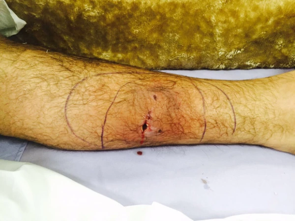 Esta fue la herida que le hizo su perro en la pantorrilla.