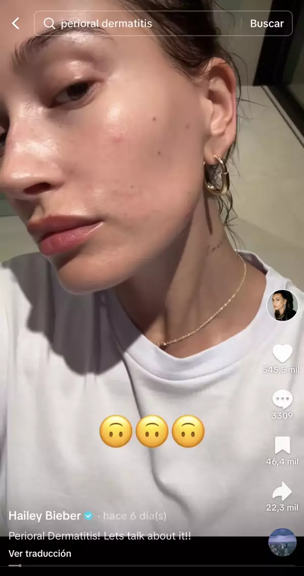 Hailey Bieber  dermatitis perioral