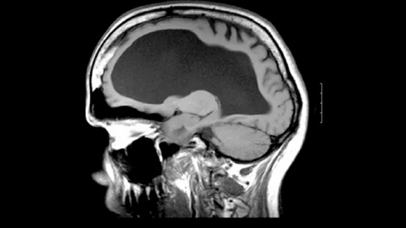 hidrocefalia tomografia