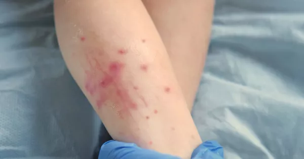 ¿Qué es el sarampión y cuáles son sus síntomas? La UNAM alerta por contagios 