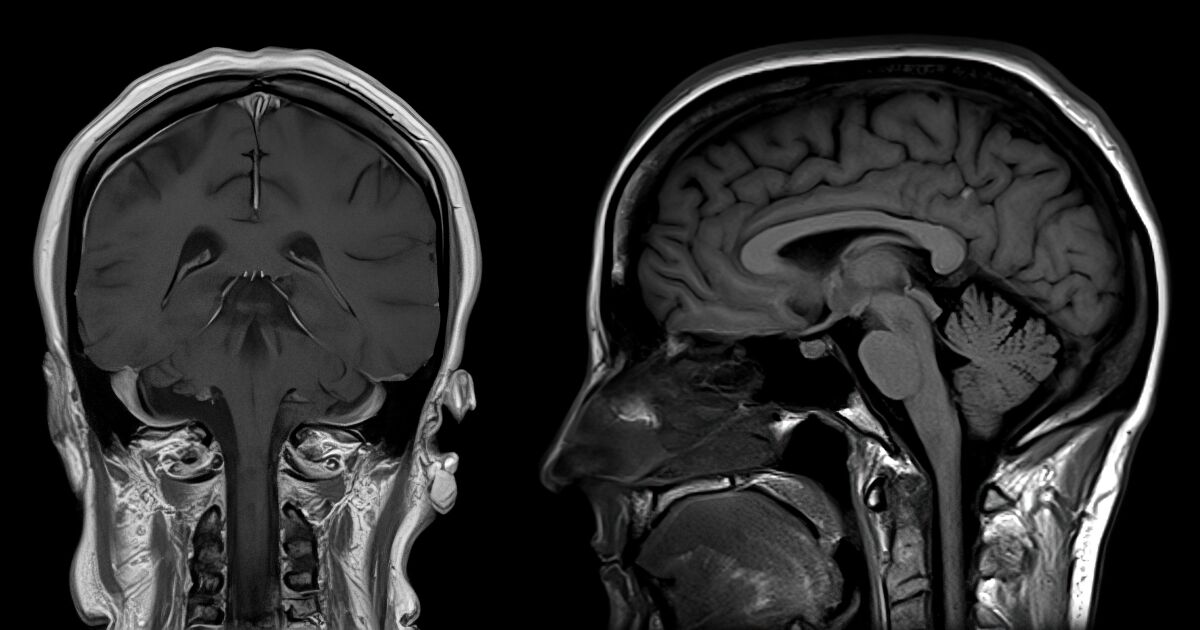 What is COVID brain fog?