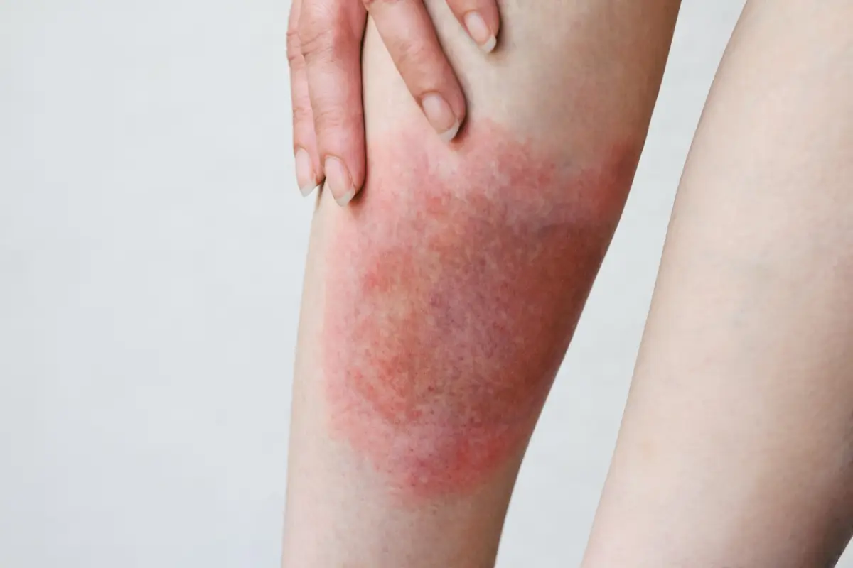 que-es-enfermedad-lyme