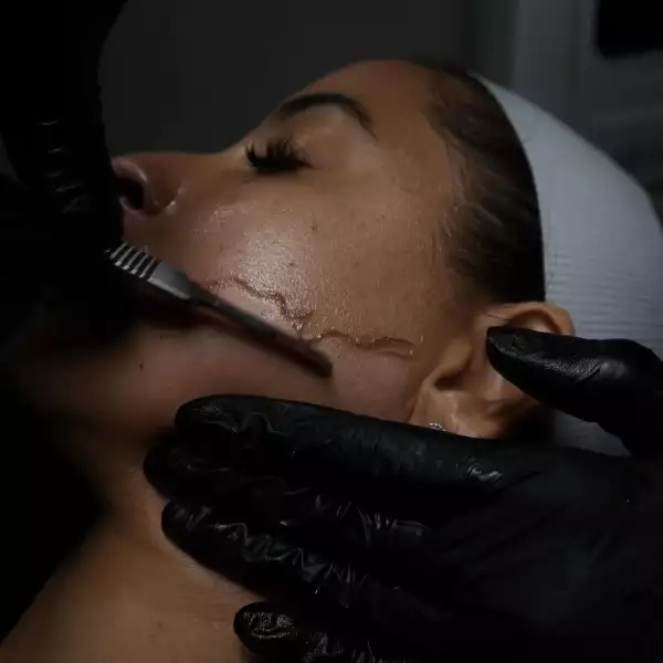 procedimiento dermaplaning .jpg
