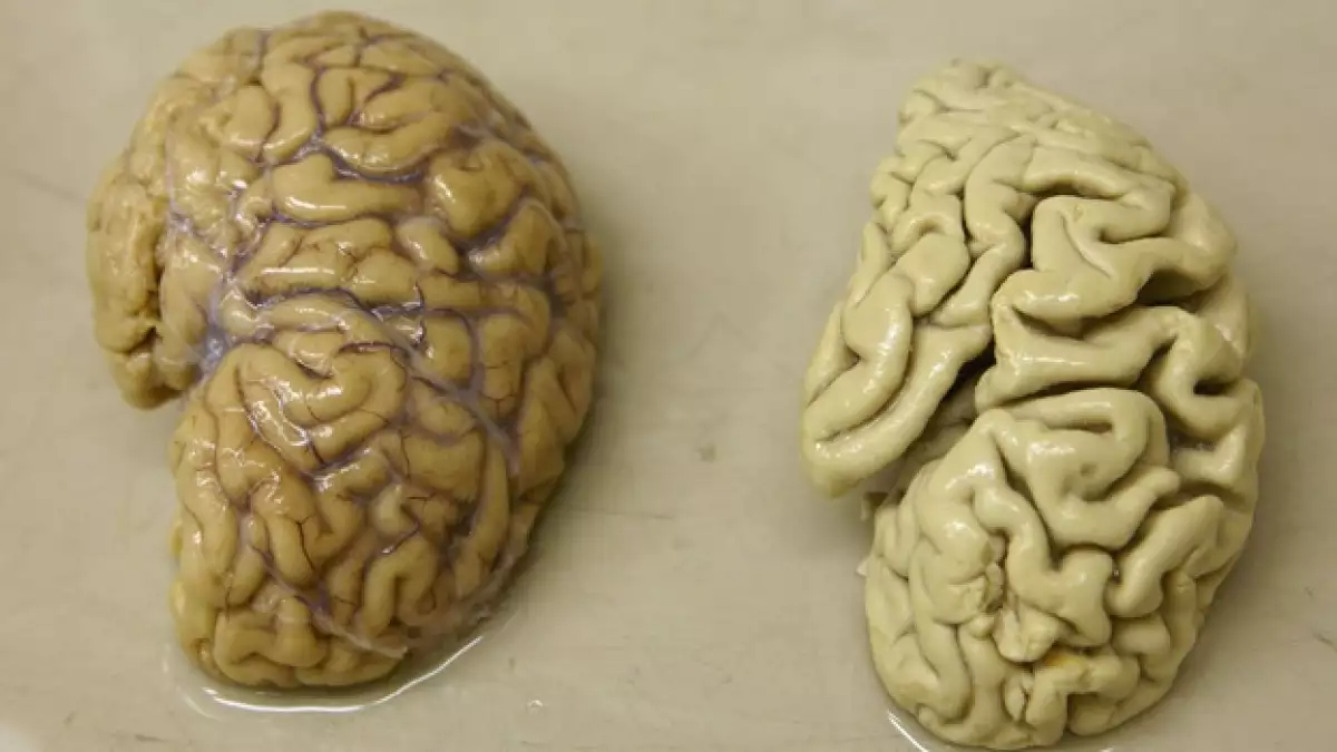 brain