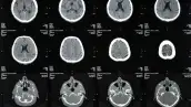 CTE enfermedad cerebro NFL .png