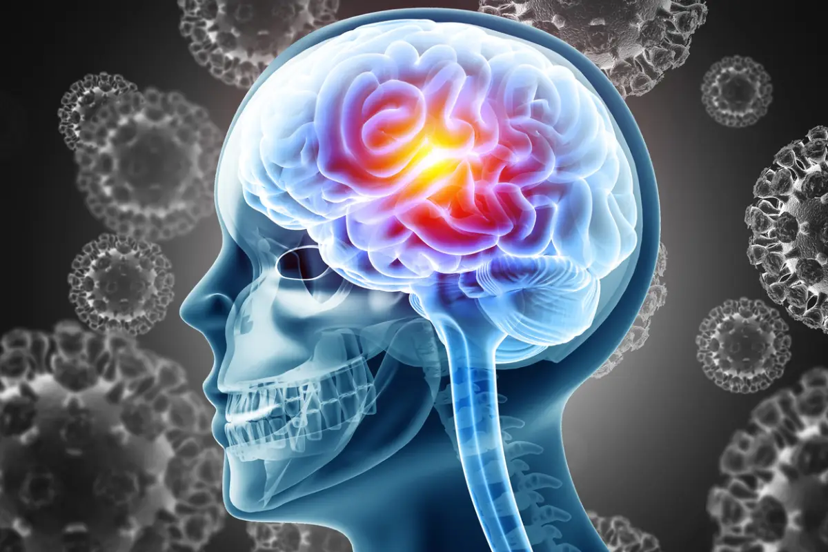 Meningitis, inflamación grave de las membranas protectoras que rodean el cerebro y la médula espinal. Infección por virus o bacterias. Ilustración en 3D