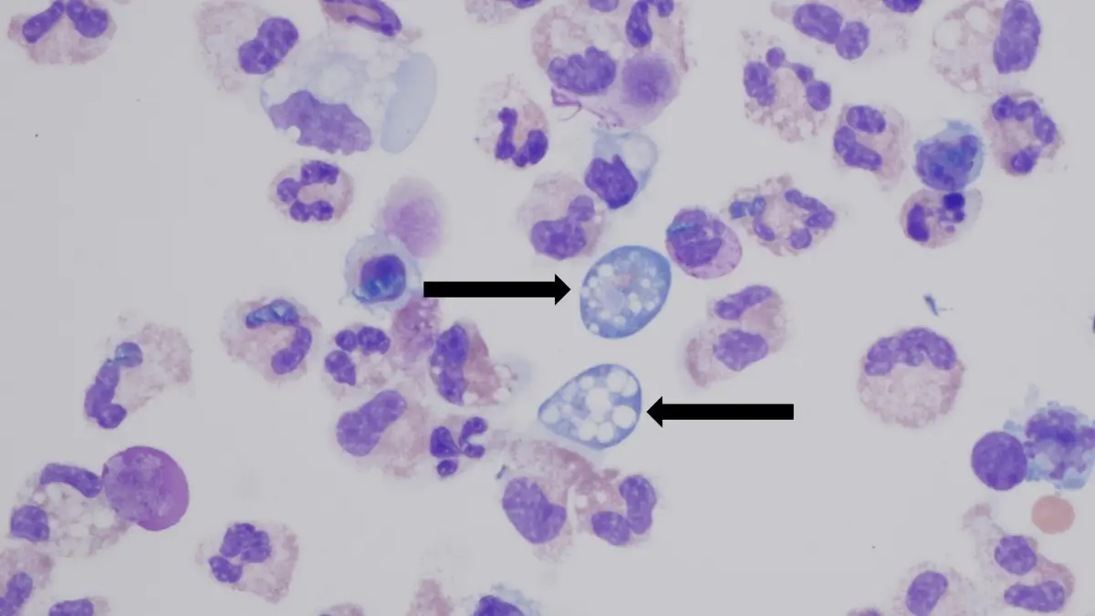 Ameba comecerebros en color azul que infectan a las células del cerebro en color morado.jpg