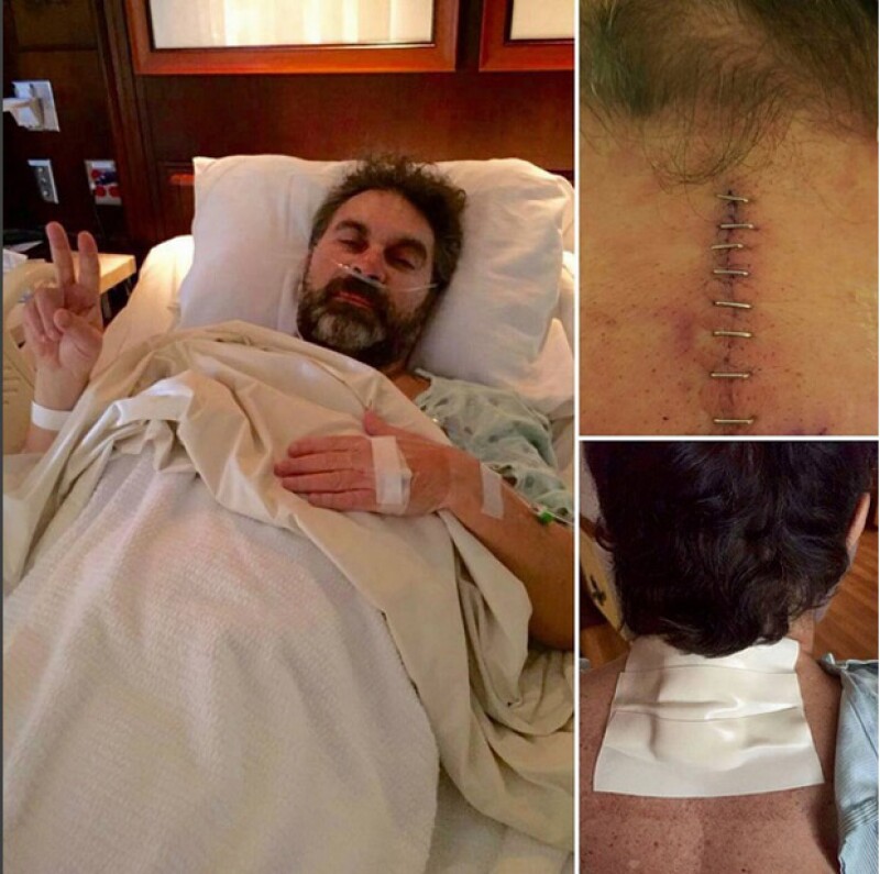 Mijares mostró en foto su herida tras la cirugía.