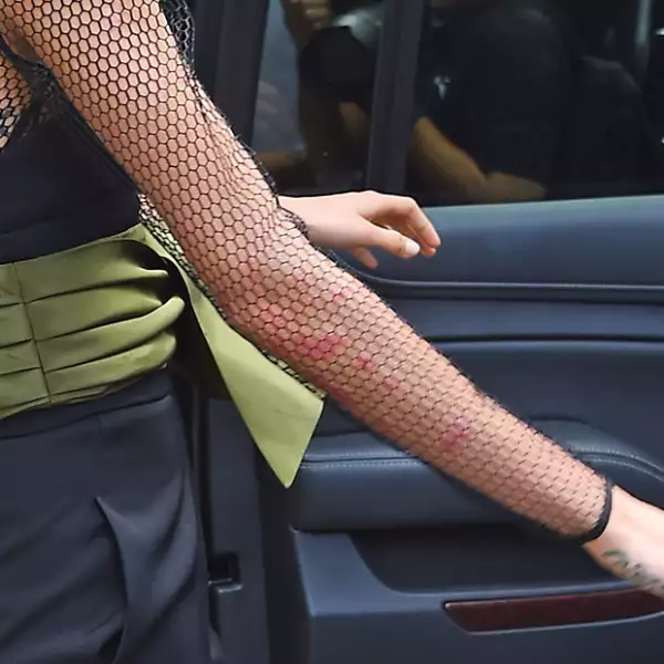 Desde hace días la modelo ha dejado ver los signos de la psoriasis.