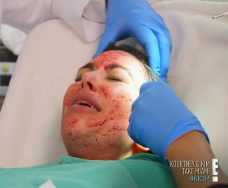 La estrella de reality show no sólo mostró ante millones de espectadores en televisión su facial llamado `vampiro´, también subió fotos a su cuenta de Instagram.