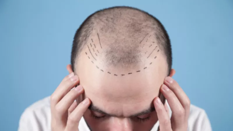 trasplante de cabello .png