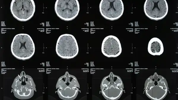 CTE enfermedad cerebro NFL .png