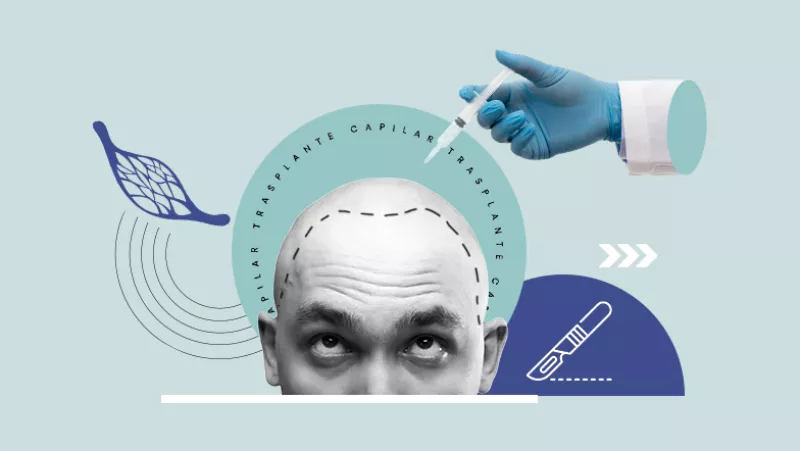 Trasplante capilar y los aspectos que debes saber