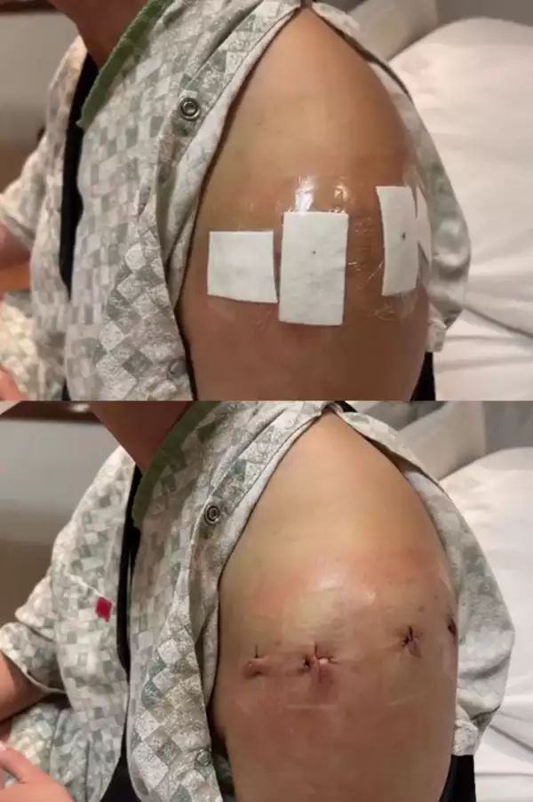 Lupita Jones impacta con operación en el hombro fotos