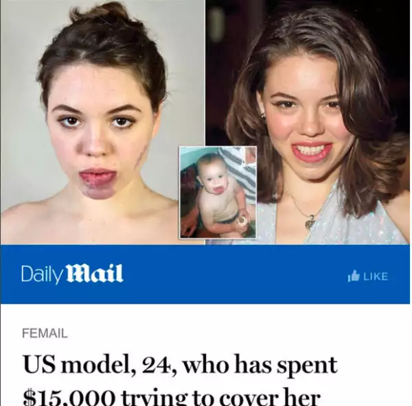 En entrevista con Daily Mail, Celina reveló que en sus 24 años de vida ha gastado 15 mil dólares entre tratamientos y operaciones en su cara.