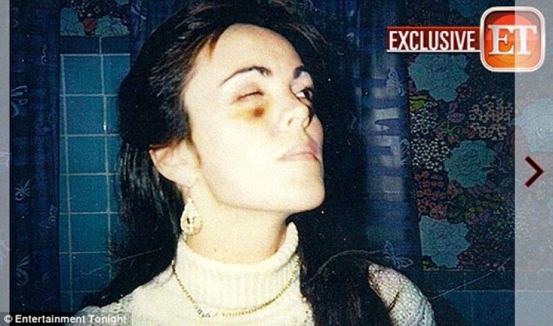 El ojo morado fue producto de los golpes de su ex-esposo, según la entrevista concedida a New York Daily News.