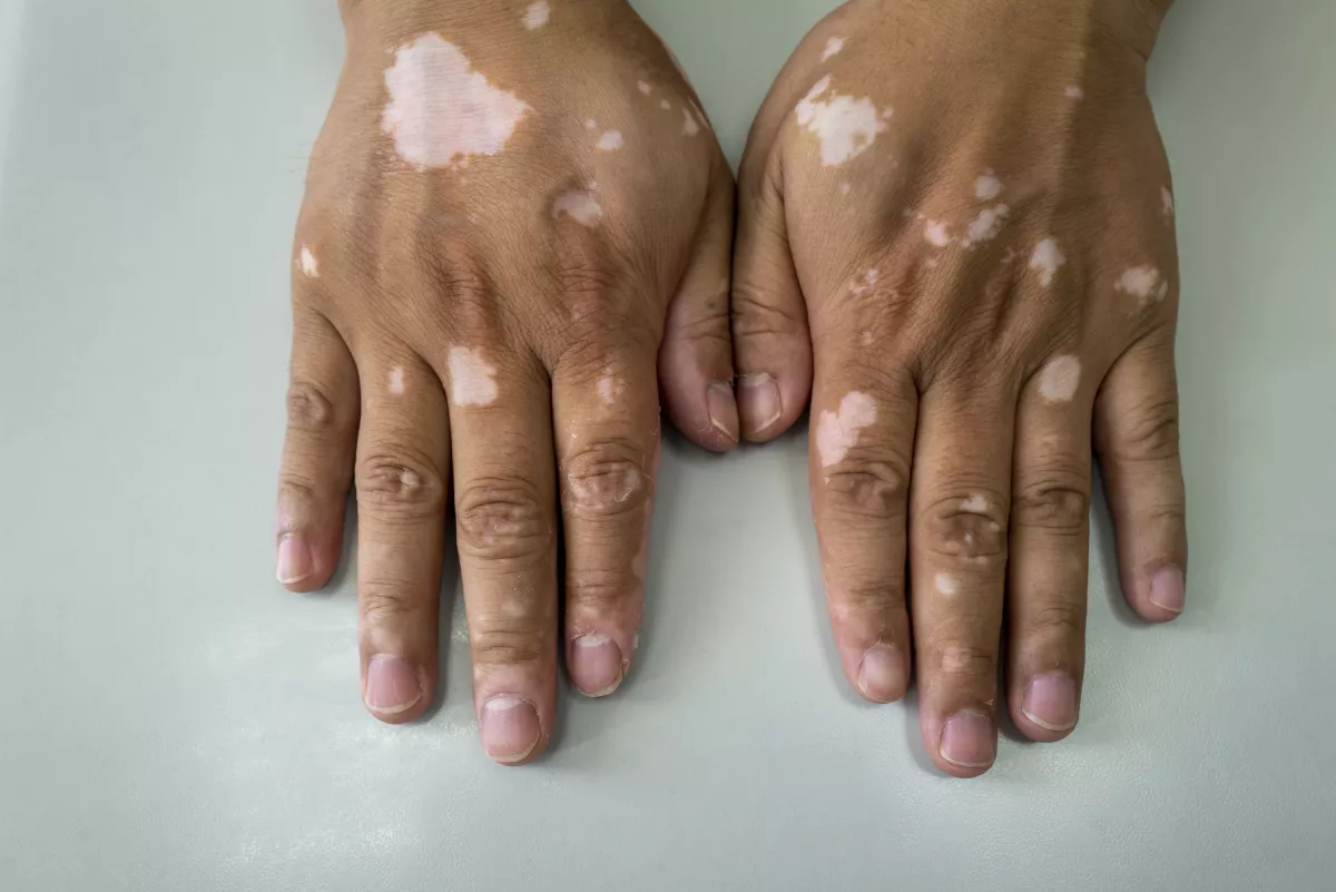 vitiligo sintomas