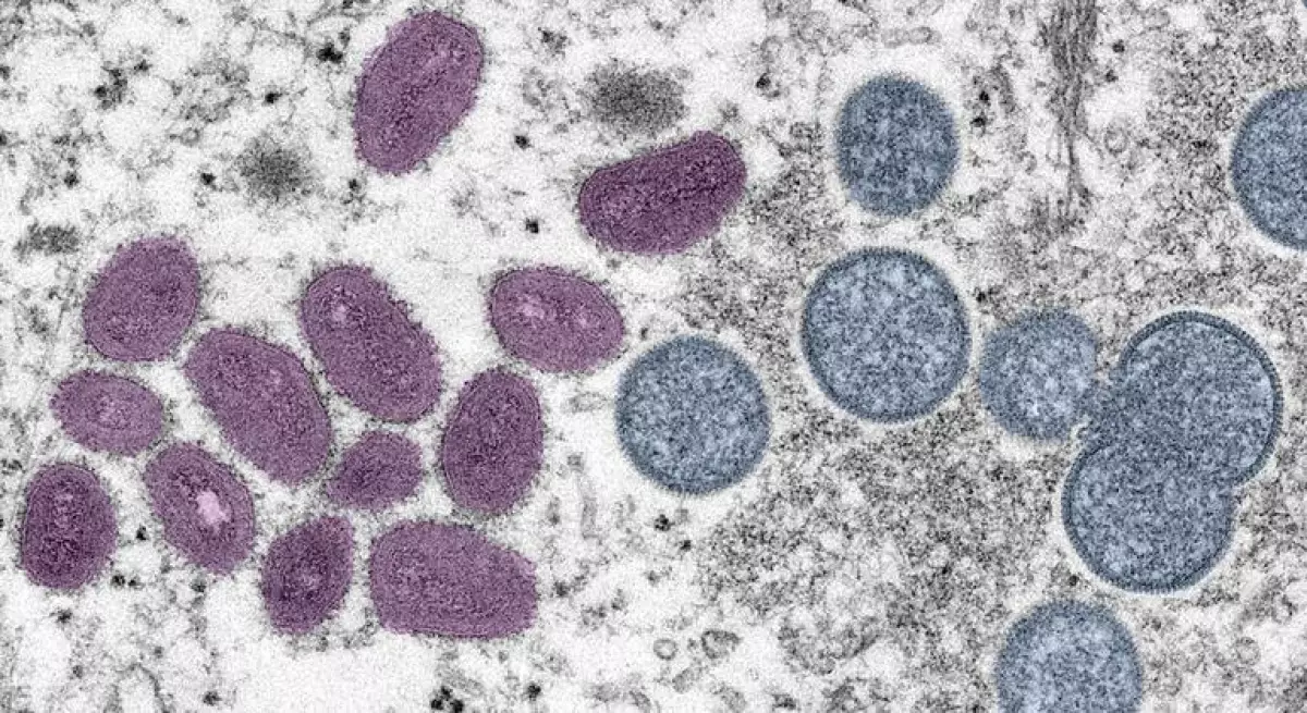 Lo que debes saber de la mpox: síntomas, vías de contagio y qué tan peligrosa es