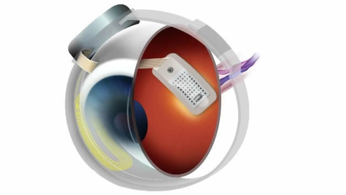 Una prótesis se implanta quirúrgicamente en la superficie de la retina.