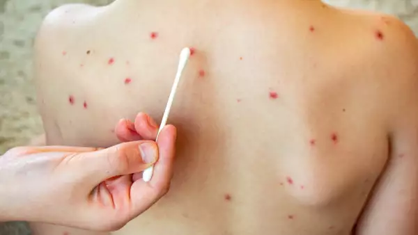 ¿El sarampión es contagioso? Estos son los síntomas en niños y adulto